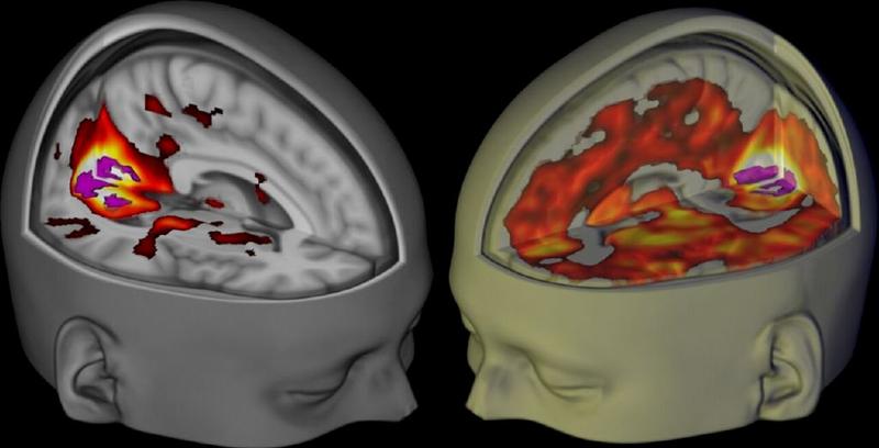 MRi brain scan imaging 