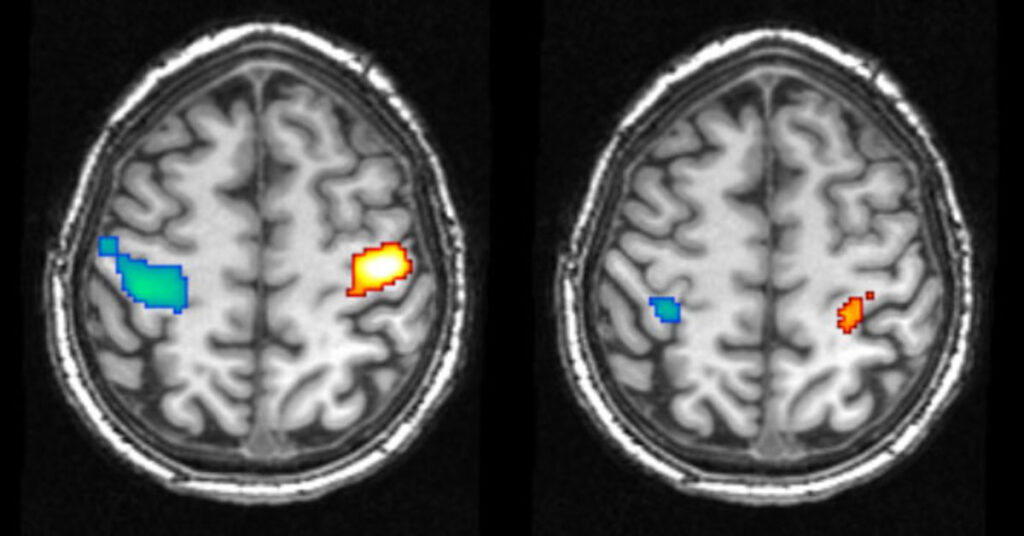 MRi mozku zobrazující sny